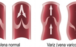 Varices